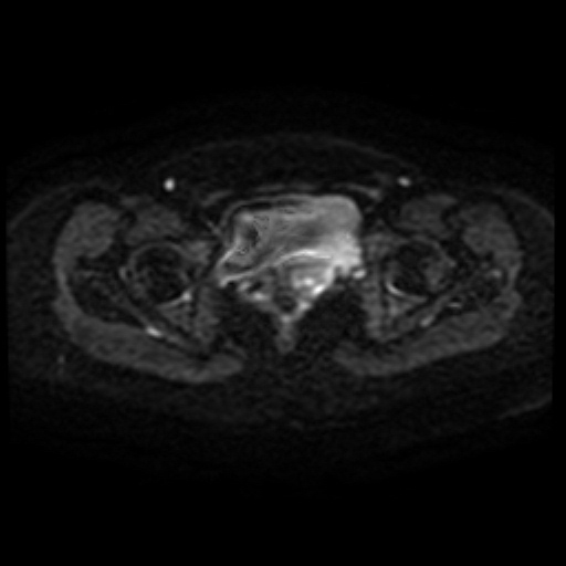Adenoma malignum of cervix (Radiopaedia 66441-75705 Axial DWI 43).jpg