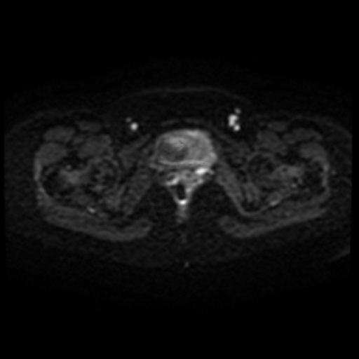 Adenoma malignum of cervix (Radiopaedia 66441-75705 Axial DWI 45).jpg
