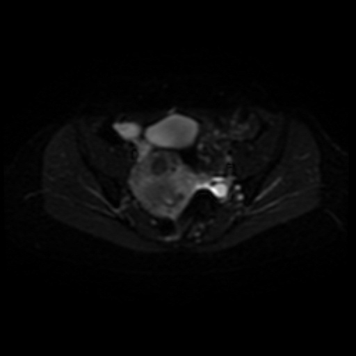 File:Adenoma malignum of cervix (Radiopaedia 66441-75705 Axial DWI 7).jpg