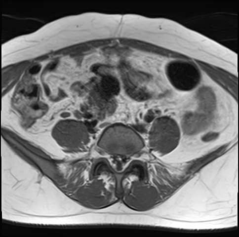 File:Adenomyosis - ovarian endometriomas (Radiopaedia 67031-76350 Axial T1 4).jpg