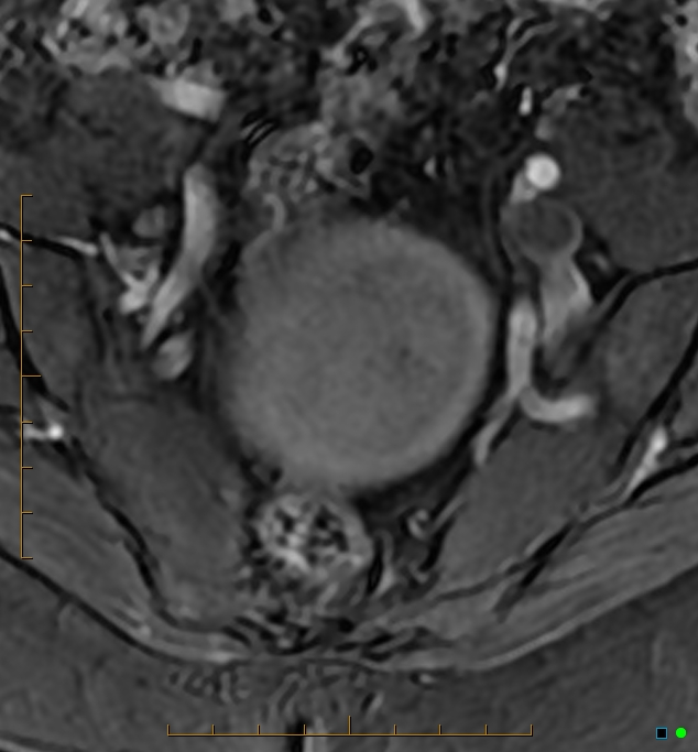 Adenomyosis uterus with hematometra (Radiopaedia 45779-50011 Axial T1 C+ fat sat 6).jpg