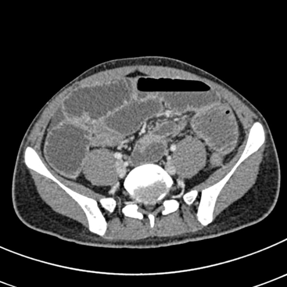 File:Adhesional small bowel obstruction (Radiopaedia 52107-57980 Axial C+ portal venous phase 89).jpg