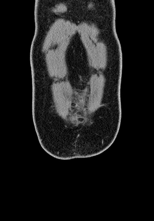 Adhesional small bowel obstruction (Radiopaedia 58900-66131 Coronal C+ portal venous phase 57).jpg