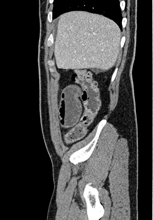 Adhesional small bowel obstruction (Radiopaedia 58900-66131 Sagittal C+ portal venous phase 42).jpg