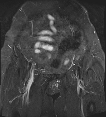 File:Adnexal multilocular cyst (O-RADS US 3- O-RADS MRI 3) (Radiopaedia 87426-103754 Coronal T2 fat sat 6).jpg