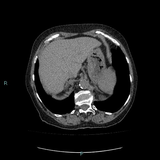 File:Adrenal collision tumor (ACT) (Radiopaedia 48462-53379 Axial non-contrast 10).jpg