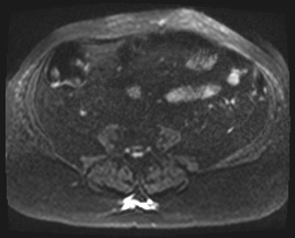 Adrenal cortical carcinoma (Radiopaedia 64017-72770 Axial DWI 83).jpg