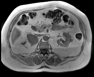 File:Adrenal cortical carcinoma (Radiopaedia 64017-72770 Axial T1 in-phase 36).jpg
