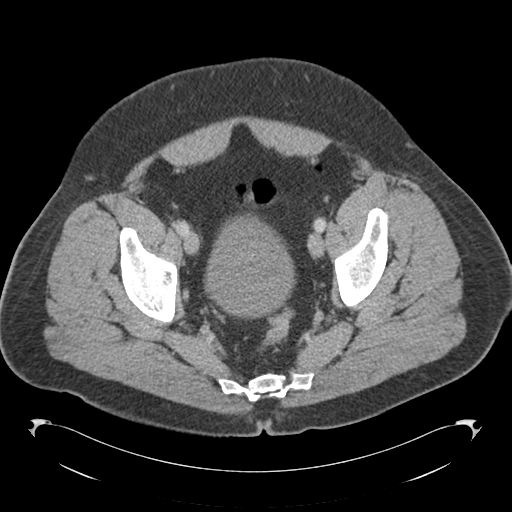 Adrenal cyst (Radiopaedia 45625-49776 Axial C+ portal venous phase 85).png