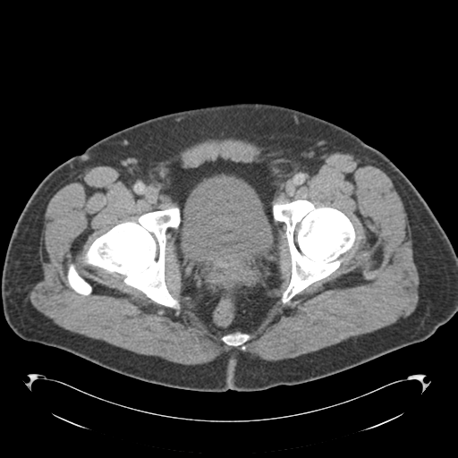File:Adrenal cyst (Radiopaedia 45625-49776 Axial C+ portal venous phase 94).png