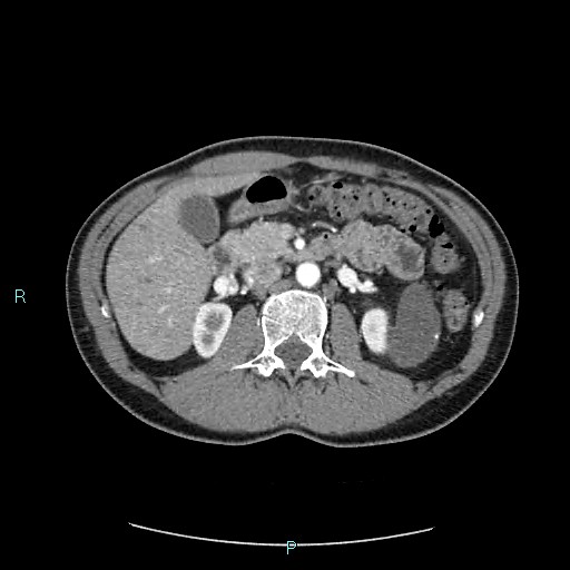 Adrenal cystic lymphangioma (Radiopaedia 83161-97534 Axial C+ arterial phase 37).jpg