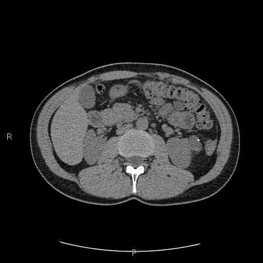 Adrenal cystic lymphangioma (Radiopaedia 83161-97534 Axial non-contrast 41).jpg
