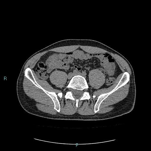 Adrenal cystic lymphangioma (Radiopaedia 83161-97534 Axial non-contrast 66).jpg