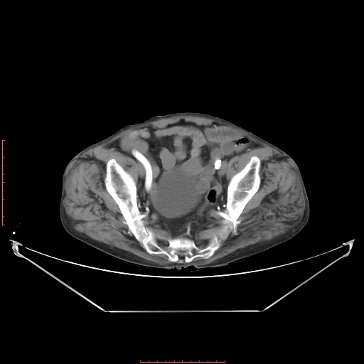 Adrenal hemangioma (Radiopaedia 68923-78668 Axial C+ arterial phase 62).jpg