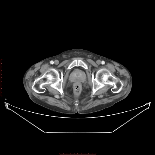 Adrenal hemangioma (Radiopaedia 68923-78668 Axial C+ portal venous phase 70).jpg