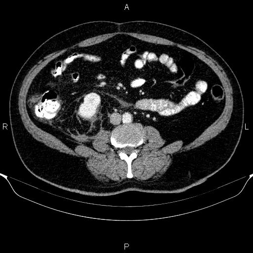 Adrenal hemorrhage (Radiopaedia 62622-70916 Axial C+ portal venous phase 109).jpg