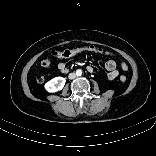 Adrenal myelolipoma (Radiopaedia 82742-96986 Axial renal cortical phase 96).jpg
