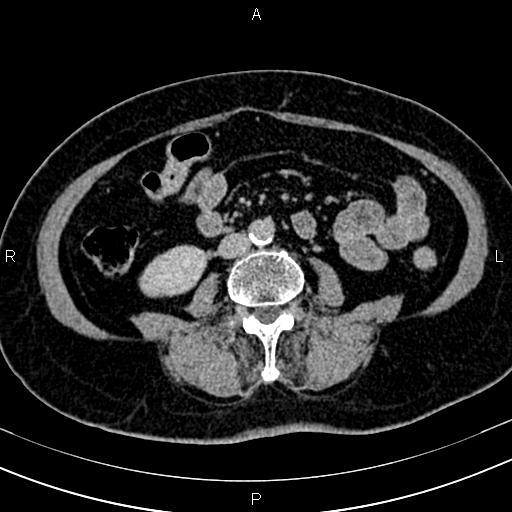 Adrenal myelolipoma (Radiopaedia 82742-96986 Axial renal excretory phase 88).jpg