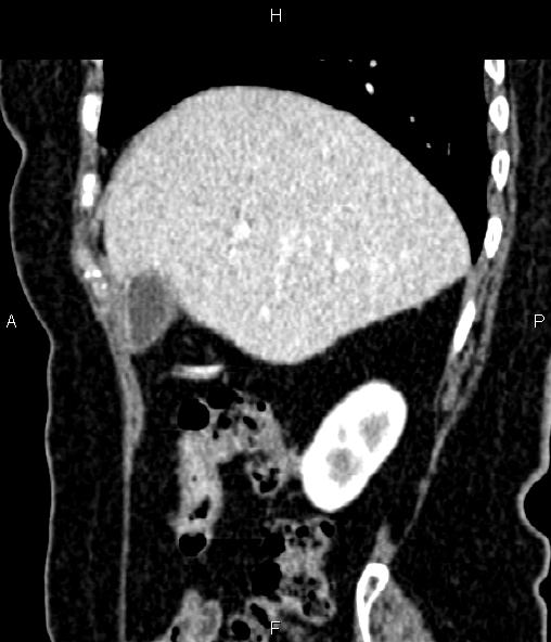 Adrenal myelolipoma (Radiopaedia 82742-96986 Sagittal renal cortical phase 31).jpg