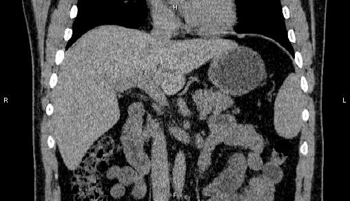 Adrenal myelolipoma (Radiopaedia 84321-99619 Coronal non-contrast 38).jpg