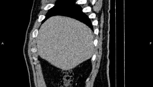 Adrenal myelolipoma (Radiopaedia 84321-99619 Sagittal non-contrast 16).jpg