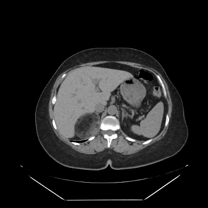 Adrenal myelolipoma - MRI (Radiopaedia 83249-97647 Axial non-contrast 18).jpg