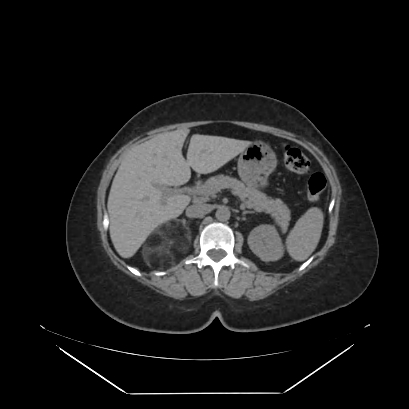 File:Adrenal myelolipoma - MRI (Radiopaedia 83249-97647 Axial non-contrast 36).jpg