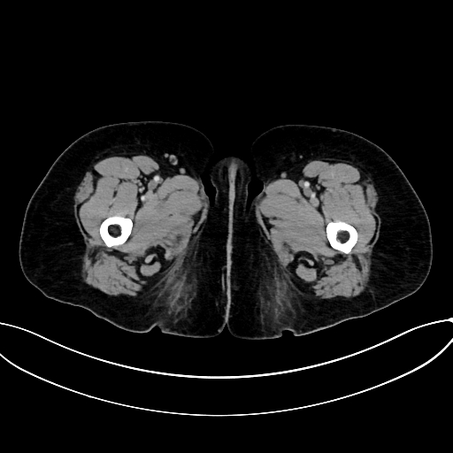 Adrenocortical carcinoma (Radiopaedia 87281-103569 Axial C+ portal venous phase 97).jpg