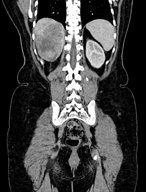 Adrenocortical carcinoma (Radiopaedia 87281-103569 Coronal C+ portal venous phase 113).jpg