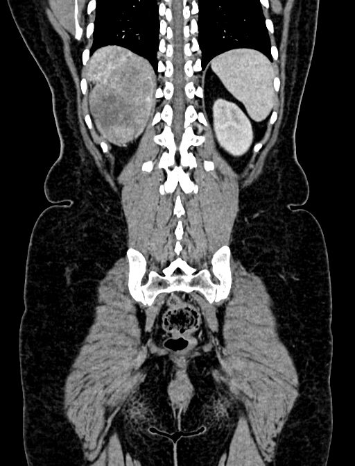 Adrenocortical carcinoma (Radiopaedia 87281-103569 Coronal C+ portal venous phase 119).jpg