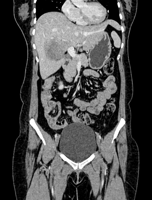 Adrenocortical carcinoma (Radiopaedia 87281-103569 Coronal C+ portal venous phase 12).jpg