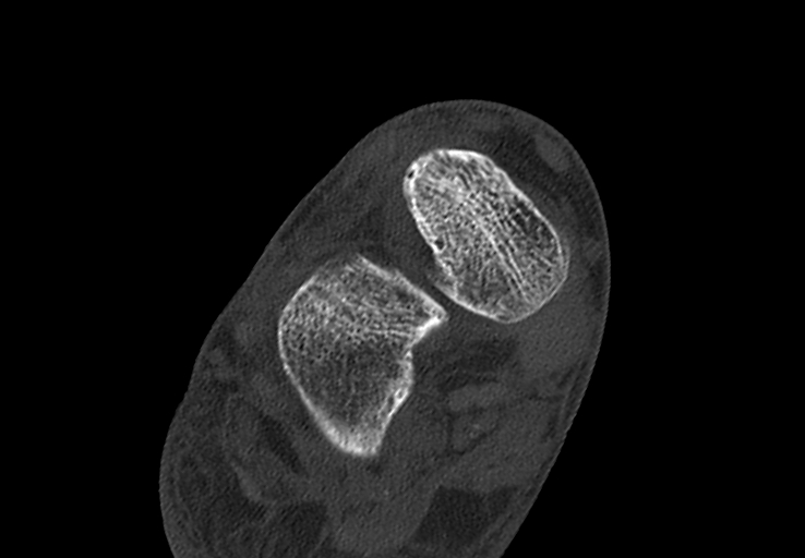 File:Advanced osteomyelitis due to open metatarsal fracture (Radiopaedia 83891-99095 Axial bone window 14).jpg