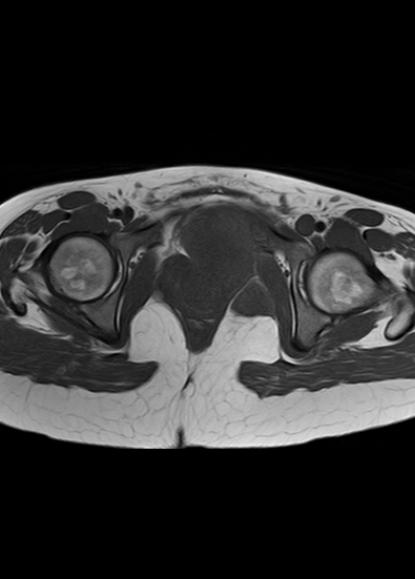 File:Aggressive angiomyxoma of the pelvis and perineum (Radiopaedia 59162-66479 T1 9).jpg