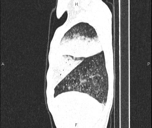 Air bronchogram in pneumonia (Radiopaedia 85719-101512 Sagittal lung window 15).jpg