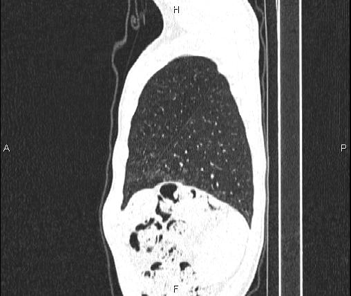 Air bronchogram in pneumonia (Radiopaedia 85719-101512 Sagittal lung window 89).jpg