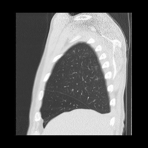 Allergic bronchopulmonary aspergillosis (ABPA) (Radiopaedia 60594-68313 Sagittal lung window 50).jpg
