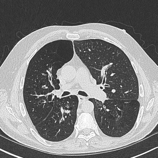 Allergic bronchopulmonary aspergillosis (Radiopaedia 44760-48571 Axial lung window 29).png