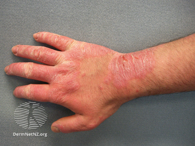 File:Allergic contact dermatitis to rubber (DermNet NZ reactions-acd2).jpg