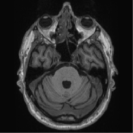 Alzheimer's disease- with Gerstmann syndrome and dressing apraxia (Radiopaedia 54882-61150 Axial T1 20).png