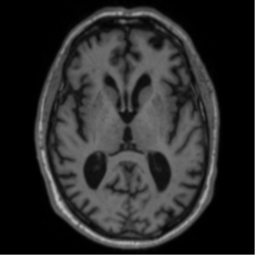 Alzheimer's disease- with Gerstmann syndrome and dressing apraxia (Radiopaedia 54882-61150 Axial T1 38).png