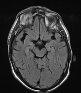 File:Alzheimer's disease- with apraxia (Radiopaedia 54763-61011 Axial FLAIR 11).png