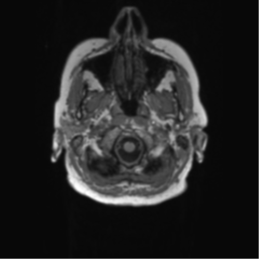 File:Alzheimer's disease (Radiopaedia 42658-45802 Axial T1 142).png