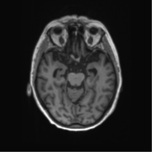 File:Alzheimer's disease (Radiopaedia 42658-45802 Axial T1 97).png