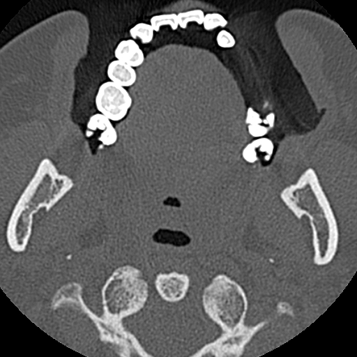 Ameloblastic fibro-odontoma (Radiopaedia 18843-18780 C 55).jpg