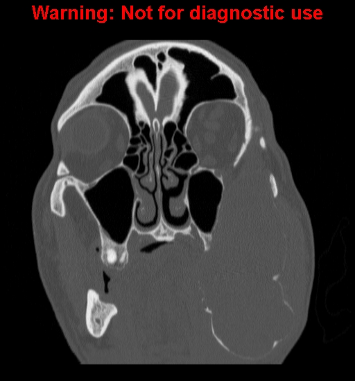 File:Ameloblastoma (Radiopaedia 13276-13280 Coronal non-contrast 10).jpg