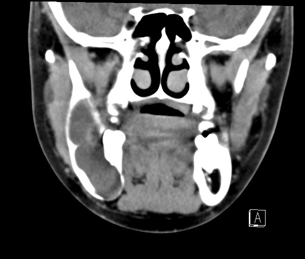 File:Ameloblastoma (Radiopaedia 26645-26793 Coronal C+ delayed 4).jpg
