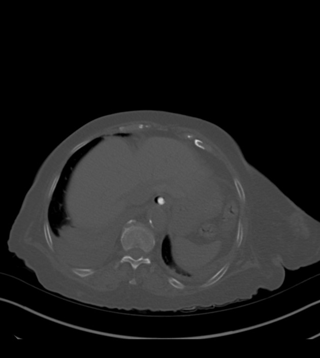 Amiodarone deposition in the liver (Radiopaedia 77587-89780 Axial bone window 69).jpg