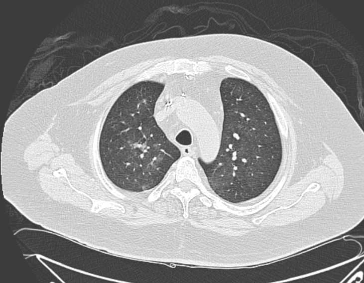 Amiodarone lung (Radiopaedia 62514-70769 Axial lung window 24).jpg