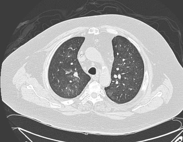 Amiodarone lung (Radiopaedia 62514-70769 Axial lung window 28).jpg