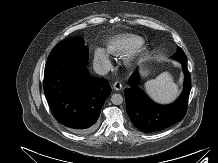 Amiodarone lung (Radiopaedia 62514-70769 Axial non-contrast 67).jpg